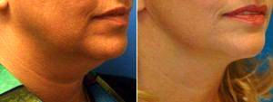 Dr. George Yang, MD, New York Facial Plastic Surgeon - Lower Facelift With Submental Liposuction (Liposuction Under The Chin)