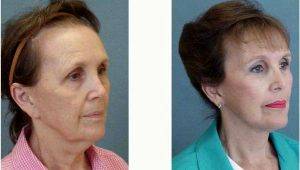 Dr. Gustavo A. Diaz, MD, Charlotte Facial Plastic Surgeon - 65 Year Old Woman Treated With Facelift