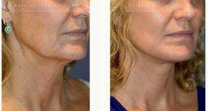 Dr. Natalie Attenello, MD, Beverly Hills Facial Plastic Surgeon - Woman Treated With Facelift