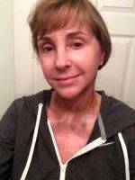 Dr. Pamela Henderson Mini Facelift Results
