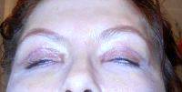 Dr. Ross A. Clevens Blepharoplasty Surgery Photo