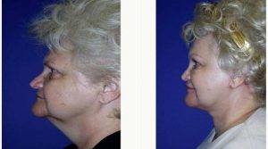 Dr. Walton Montegut, MD, Newport Beach Physician - 63 Year Old Woman Treated With Facelift