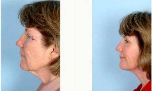 Dr. Wayne F. Larrabee, MD, Seattle Facial Plastic Surgeon - 63 Year Old Woman Treated With Facelift