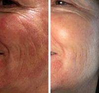 Endymed Facelift Before And After