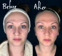 Enhance With Injectables