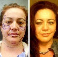 Excess Fat Is Removed During Facelft