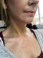 Face And Neck Lift By Dr. Patrick Flaharty