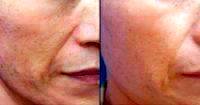 Face Plastic Surgery By Dr. Michael Elam