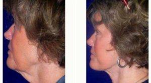 Facelift Before & After With Dr Anna Petropoulos, MD, FRCS, Boston Facial Plastic Surgeon