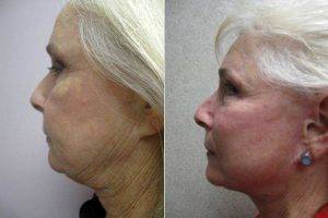 Facelift Before And After With Dr Robert N. Young, MD, FACS, San Antonio Plastic Surgeon