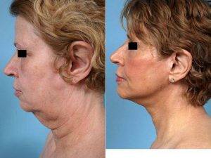 Facelift By Doctor John Y.S. Kim, MD, FACS, Chicago Plastic Surgeon
