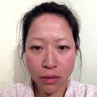Facelift For Asian People In Seattle WA