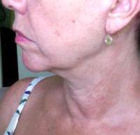 Facelift For Jowls Before And After Photos