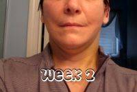 Facelift Recovery On Week 2