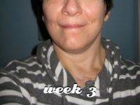Facelift Recovery Week 3 Photo