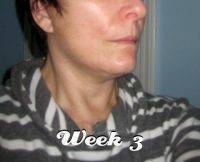 Facelift Recovery Week 3 Picture