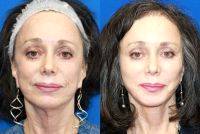 Facelift Results Last For Years