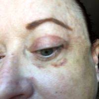 Facelift Swelling Photo (2)