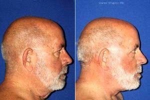 Facelift, Upper And Lower Blepharoplasty With Canthopexy. With Dr Daniel Shapiro, MD, Scottsdale Plastic Surgeon