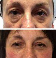Facelift Without Using A Scalpel