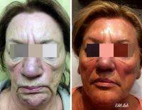Filler And Botox Can Change Lives