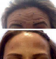 HOW DOES A LIQUID FACELIFT WORK