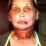 Hematoma After Facelift Pic