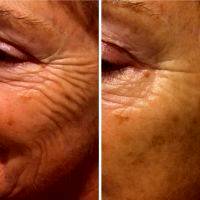 Hour Lift To Remove Wrinkles