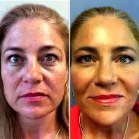 How Does A Liquid Facelift Work Pictures
