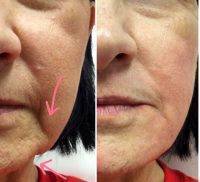 Hyaluronic Acid Face Injections Before And After
