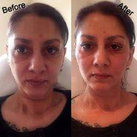 Hyaluronic Acid The Natural Facelift Before And After