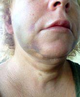 Image Of Lower Facelift Numbness