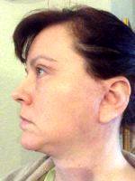 It Is Normal To Have Swelling After A Facelift For 6-8 Weeks