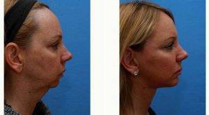 Lady In Her Early 50s Concerned With Lower Face And Neck Aging. Before & After With Dr Frank P. Fechner, MD, Worcester Facial Plastic Surgeon