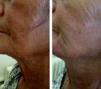 Laser Face Lift In San Diego Before And After