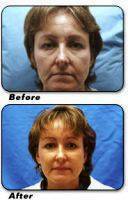 Laser Resurfacing Is Safe, Effective, And Convenient