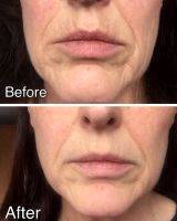 Lifting And Restoring Tone To The Face