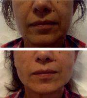 Liquid Facelift Procedure Uses Natural, Injectable Fillers To Lift And Contour The Face
