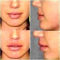 Liquid Facelift, Which Uses Dermal Fillers