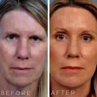 Liquid Facelift With Botox