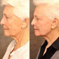 London Facelift Helps You Achieve The Beautiful, Youthful Appearance You Have Always Dreamed Of