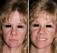 Lower Facelift Also Trims Excess Skin, Smoothing It Down To Eliminate Facial Creases
