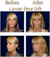 Lower Facelift Before And After Image