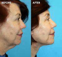 Lower Facelifting Surgery Before And After