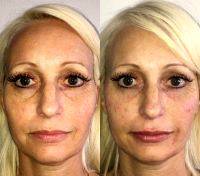 Lunch Hour Facelift Before And After