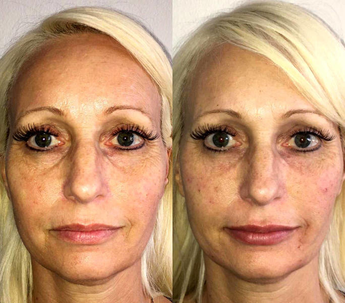 Lunch Hour Facelift Before And After Facelift Info Prices Photos