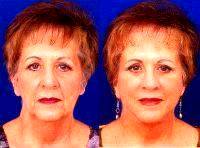 Maintenance And Enhancements During The Post-surgical Period Will Help The Facelift Results Last Even Longer