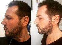 Male Lower Facelift Before And After