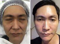 Male One Suture Facelift
