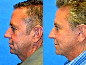 Male SMAS Facelift With Necklift And Neck Liposuction By Dr. Lynn Chiu-Collins, MD, San Francisco Facial Plastic Surgeon